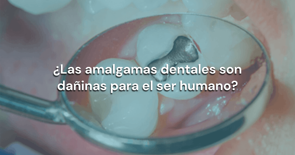 Lee más sobre el artículo ¿Las amalgamas dentales son dañinas para el ser humano?