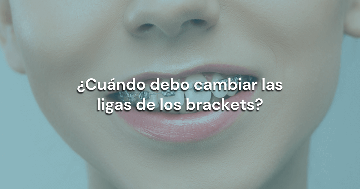 Lee más sobre el artículo ¿Cuándo debo cambiar las ligas de los brackets?