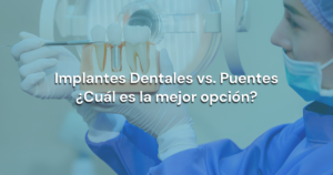 Lee más sobre el artículo Implantes Dentales vs. Puentes: ¿Cuál es la mejor opción?