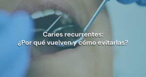 Lee más sobre el artículo Caries recurrentes: ¿Por qué vuelven y cómo evitarlas?