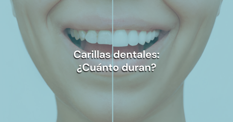 Lee más sobre el artículo Carillas dentales: ¿Cuánto duran?