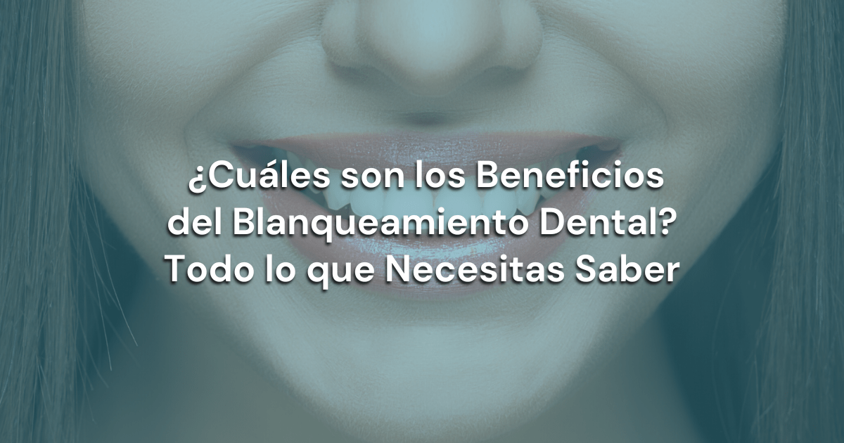 En este momento estás viendo ¿Cuáles son los Beneficios del Blanqueamiento Dental? Todo lo que Necesitas Saber