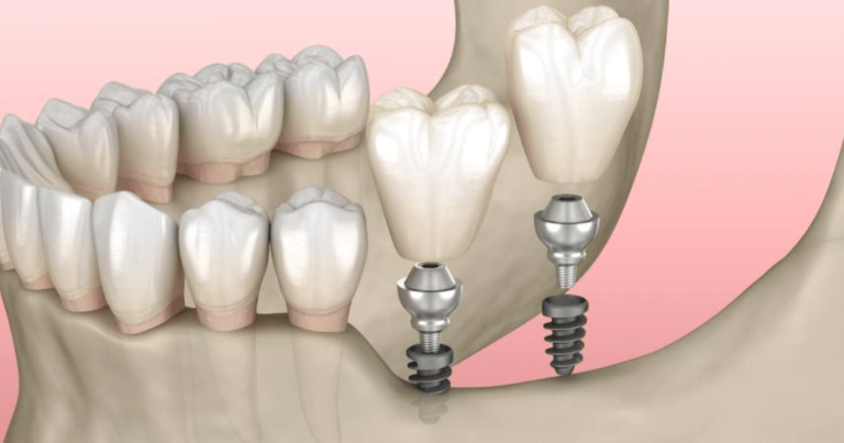 Lee más sobre el artículo ¿Se pueden reemplazar todos los dientes si no tienes suficiente hueso en las encías?