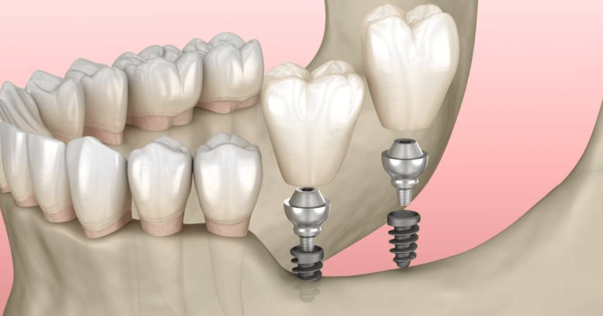 En este momento estás viendo ¿Se pueden reemplazar todos los dientes si no tienes suficiente hueso en las encías?
