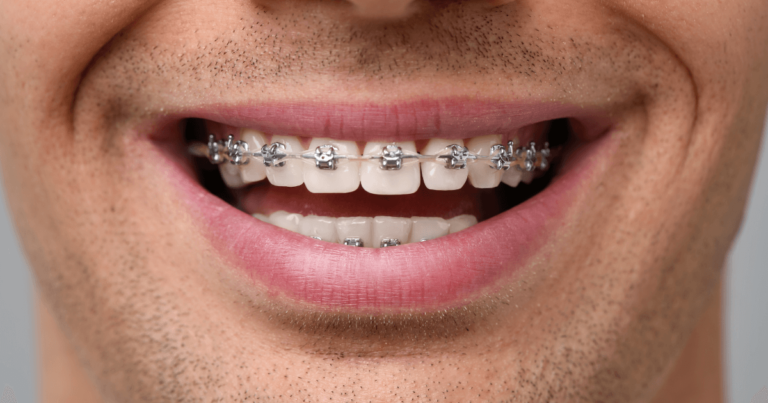 Lee más sobre el artículo ¿Sabías que con brackets tu hueso también se mueve?