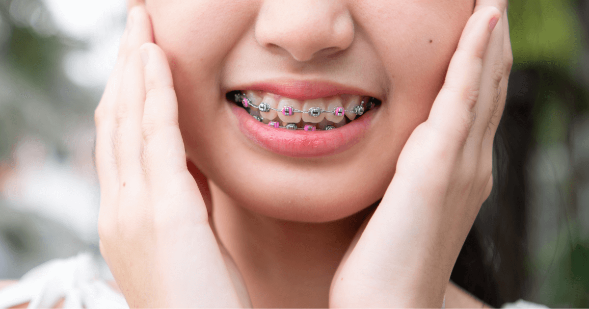 En este momento estás viendo El lado oscuro de los brackets: no es el dolor… es cómo esconden comida