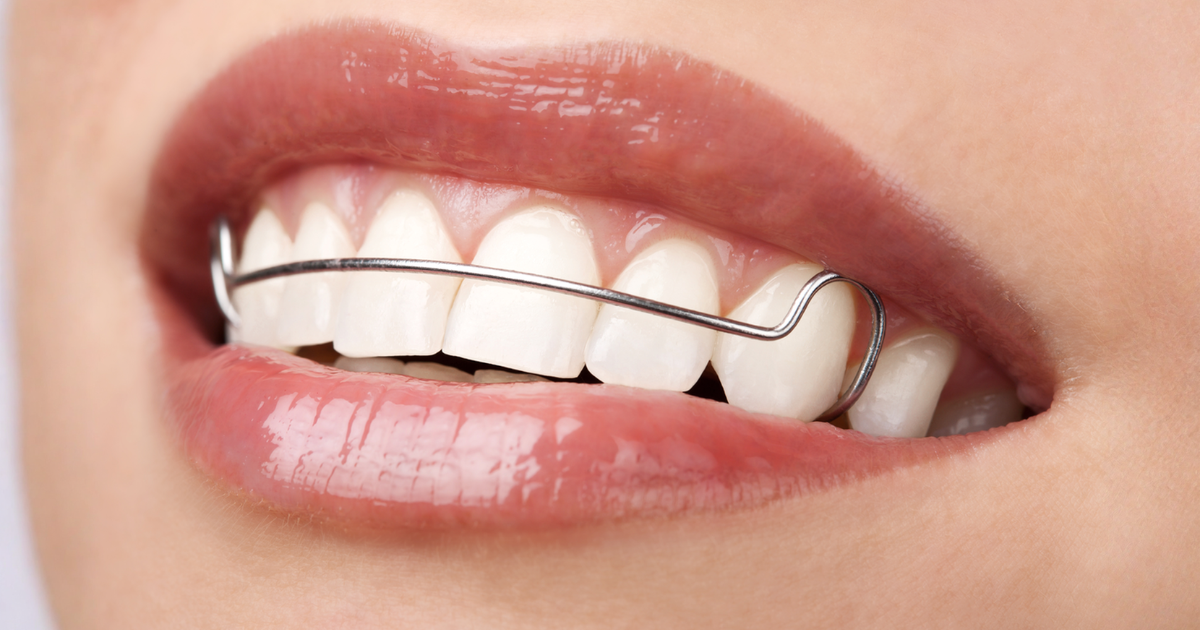 Lee más sobre el artículo Retenedor dental: cómo mantener tus dientes rectos después de la ortodoncia