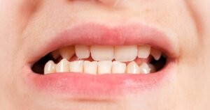 Lee más sobre el artículo Mordida cruzada: cómo detectarla a tiempo y qué hacer para corregirla